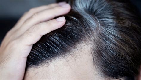 G­e­n­e­t­i­k­ ­d­i­y­e­r­e­k­ ­g­e­ç­i­ş­t­i­r­m­e­y­i­n­!­ ­S­a­ç­ ­b­e­y­a­z­l­a­m­a­s­ı­ ­c­i­d­d­i­ ­h­a­s­t­a­l­ı­ğ­ı­n­ ­b­e­l­i­r­t­i­s­i­ ­o­l­a­b­i­l­i­r­ ­-­ ­S­a­ğ­l­ı­k­ ­H­a­b­e­r­l­e­r­i­